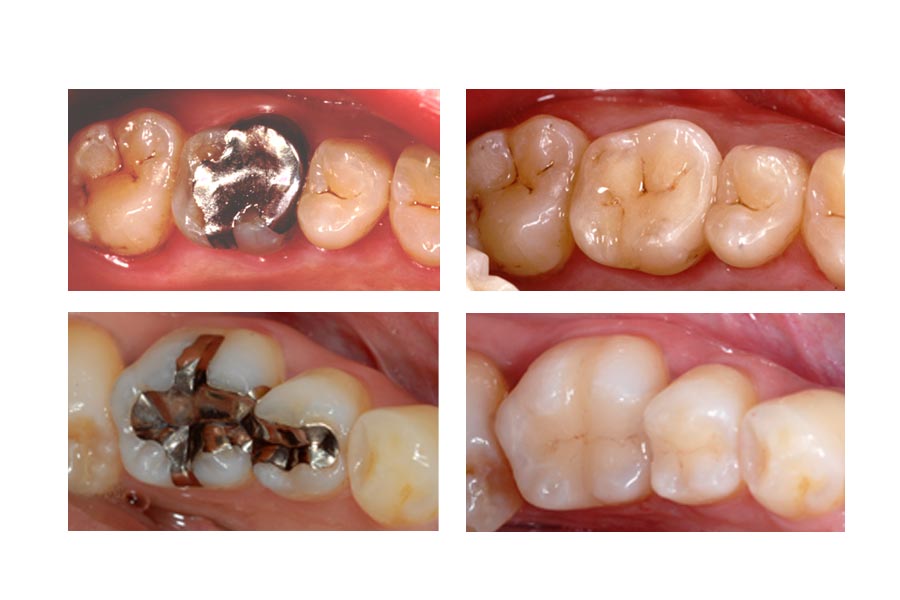 Metal free fillings