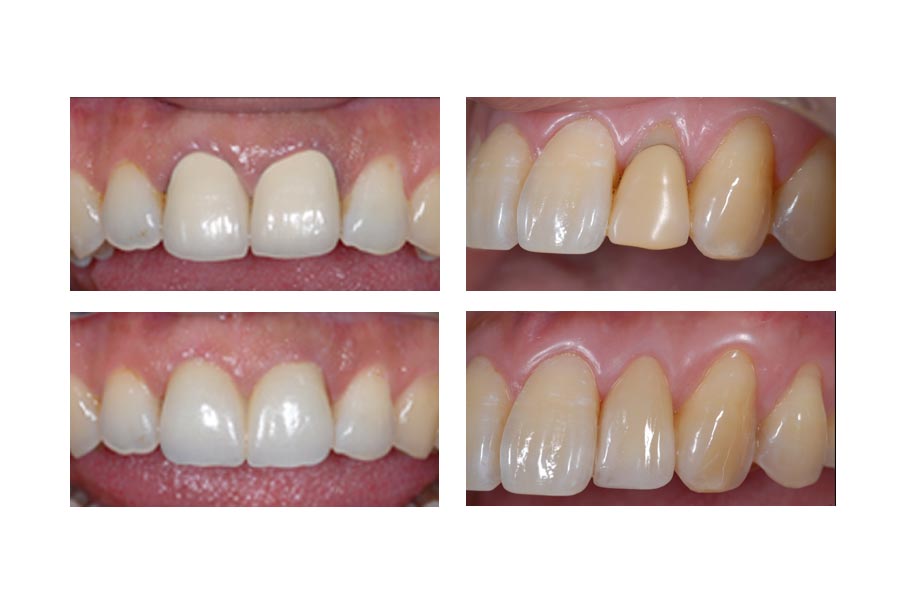 tooth colored restorations