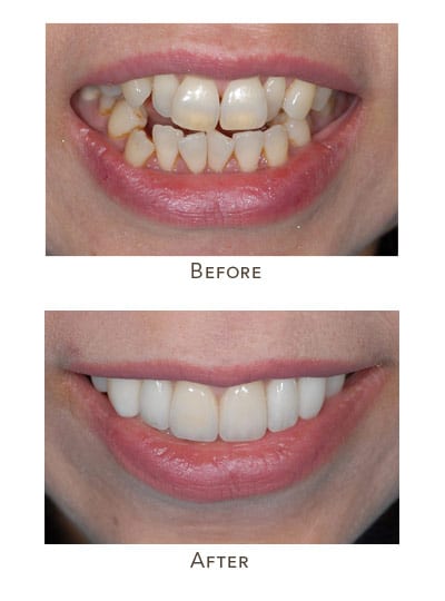 Before & After Image of Crowded Teeth Treatment West Houston TX
