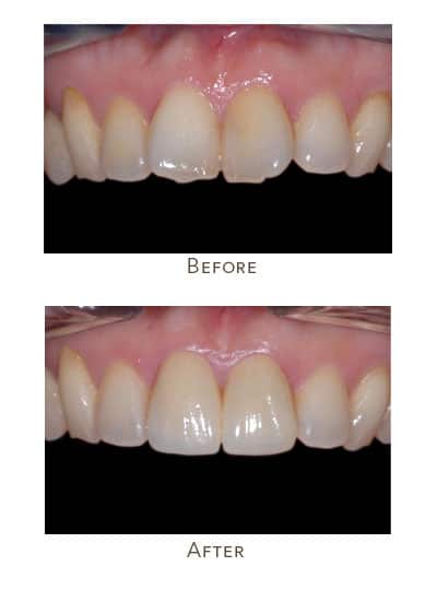 Before & After Image of Protruding Teeth Treatment West Houston TX