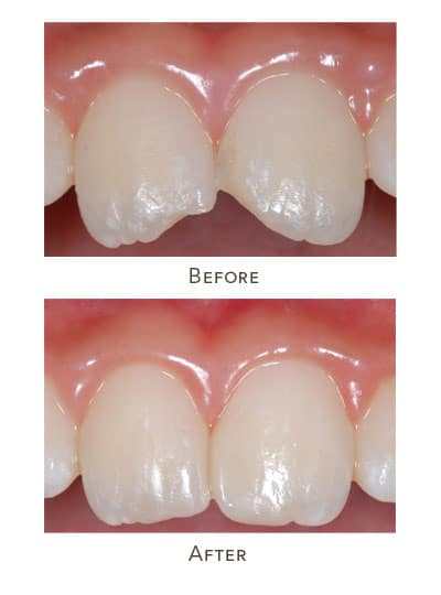Before & After Image of Tooth Bonding West Houston TX