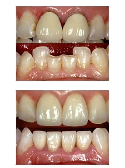 Before & After Image of Dental Crown West Houston TX