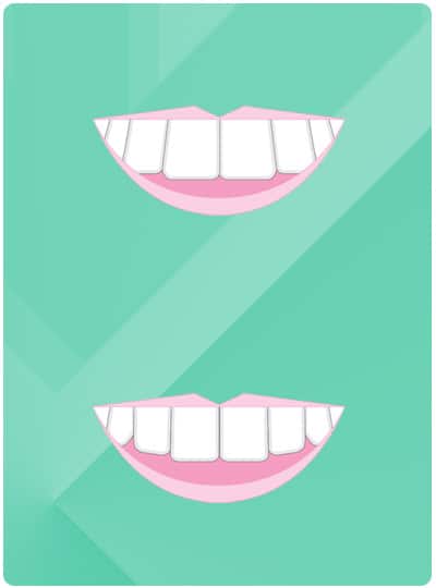 Before & After Image of buck teeth West Houston TX