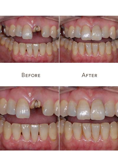 front upper tooth replacement
