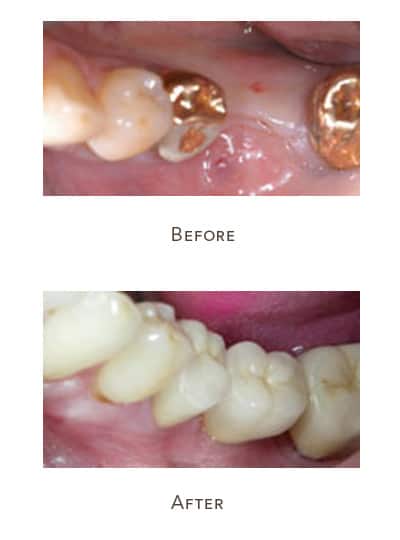 Before & After Image of Tooth Implants West Houston TX