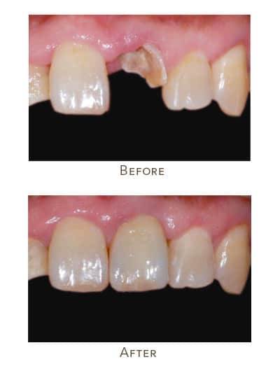 missing front tooth
