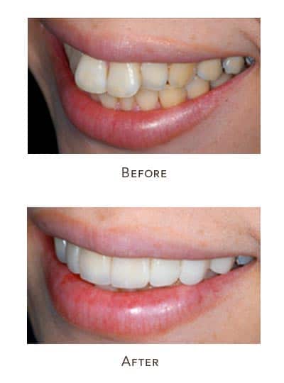 Before & After Image of Protruding Teeth West Houston TX