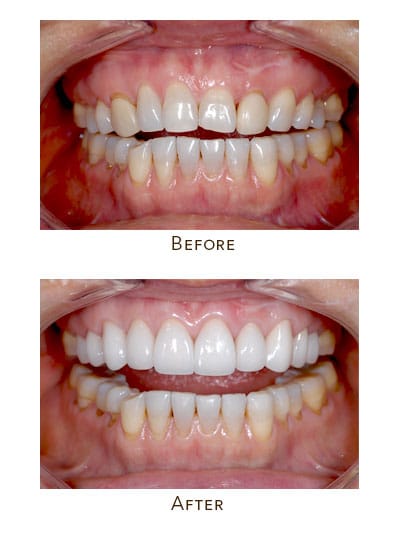 Before & After Image of Uneven Gum Line Energy Corridor TX