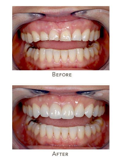 uneven gumline worn upper front teeth