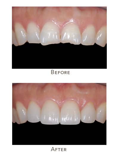 uneven incisors