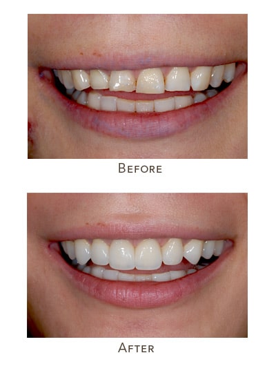 uneven upper teeth size