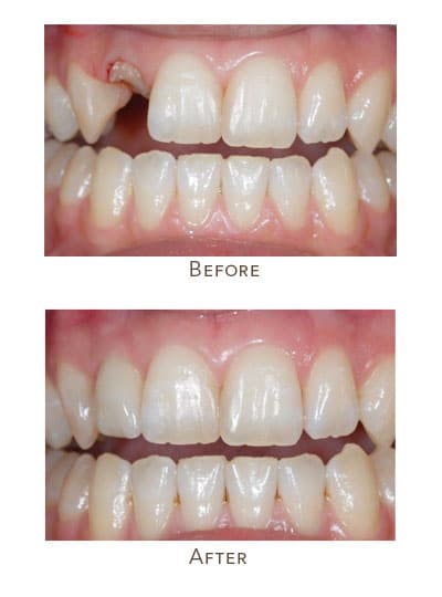 upper front tooth replacment