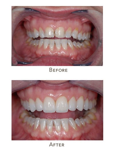 Before & After Image of Same Day Smile Makeover West Houston