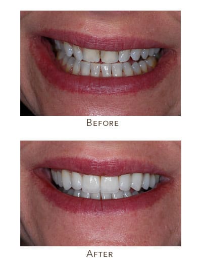 Before & After Image of Same Day Smile Makeover West Houston TX