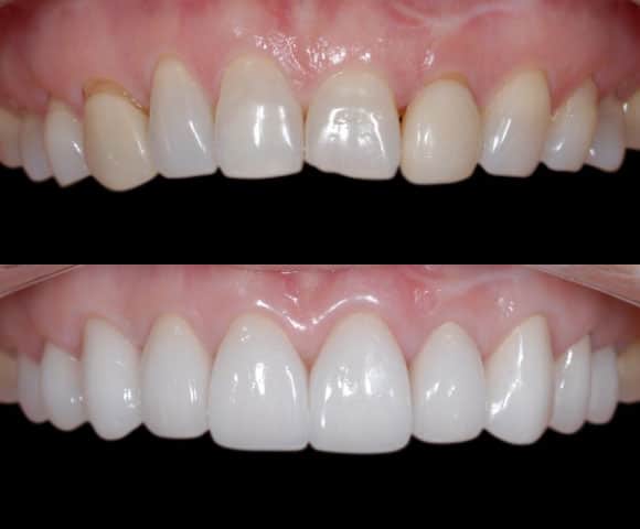 uneven gumline uneven tooth shapes 580x480