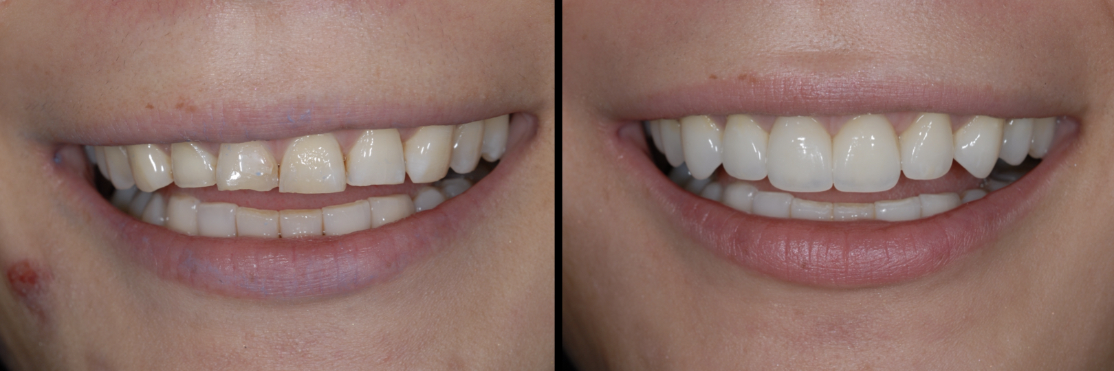 Before and After Image: Veneers