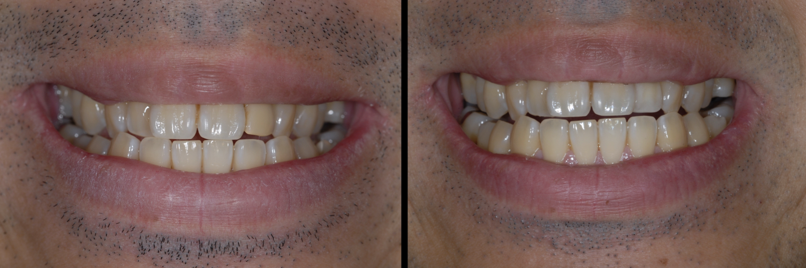 Before and After Image: Zirconia Crown - front