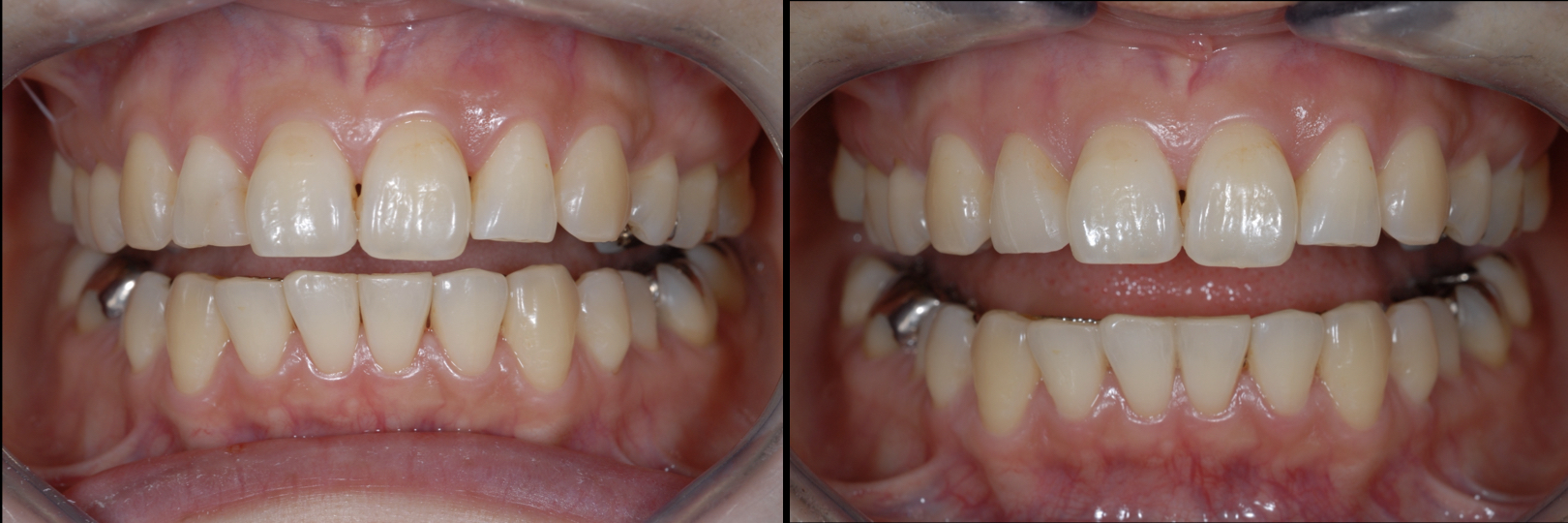 Before and After Image: Feldspathic Veneers - front
