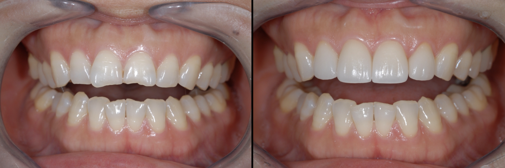 Before and After Image: Feldspathic Veneers - front
