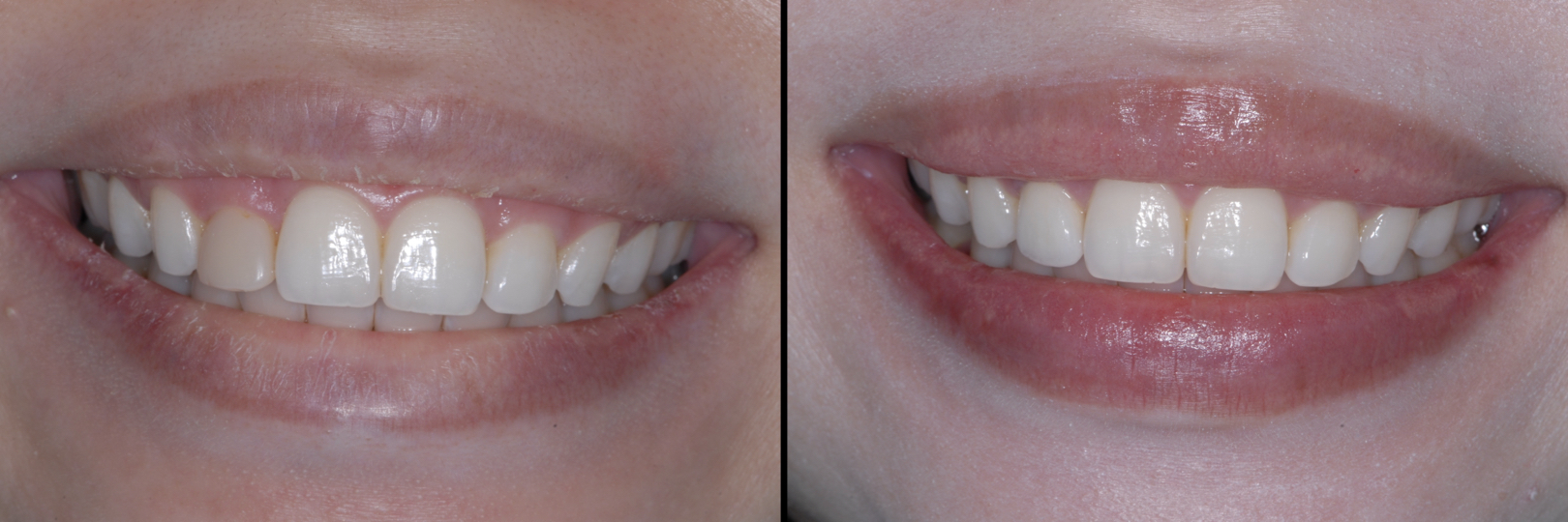 Before and After Image: Emax Crown - front