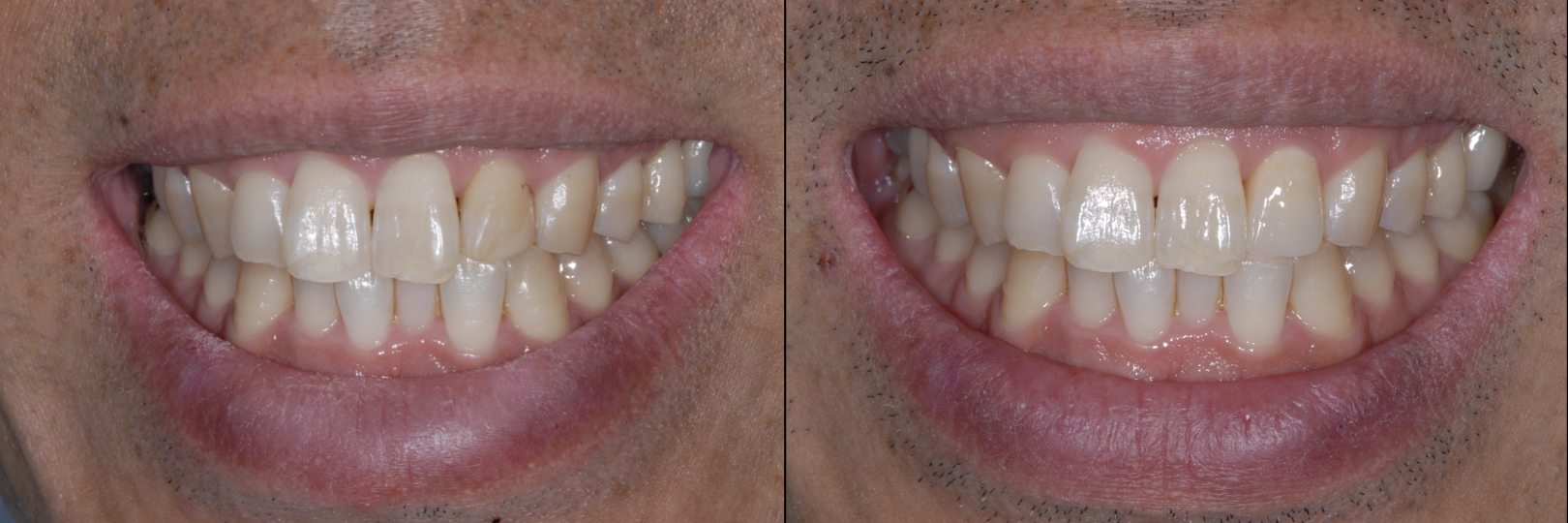Before and After Image: Zirconia Crown - front