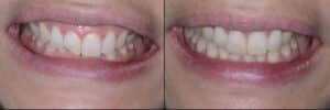 Before-and-after of composite dental bonding on a front tooth, showing cosmetic repair results