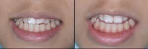 Results of chipped front tooth repair with composite bonding, cosmetic dentistry in Houston.