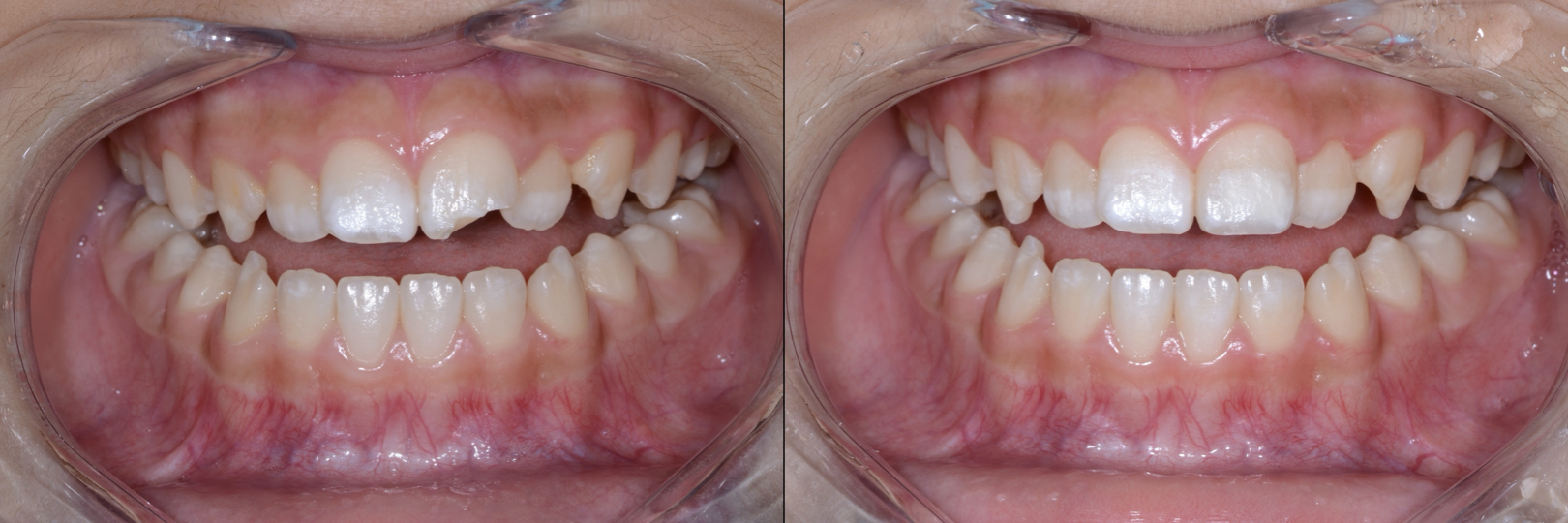 Before and After Image: Composite Bonding - front