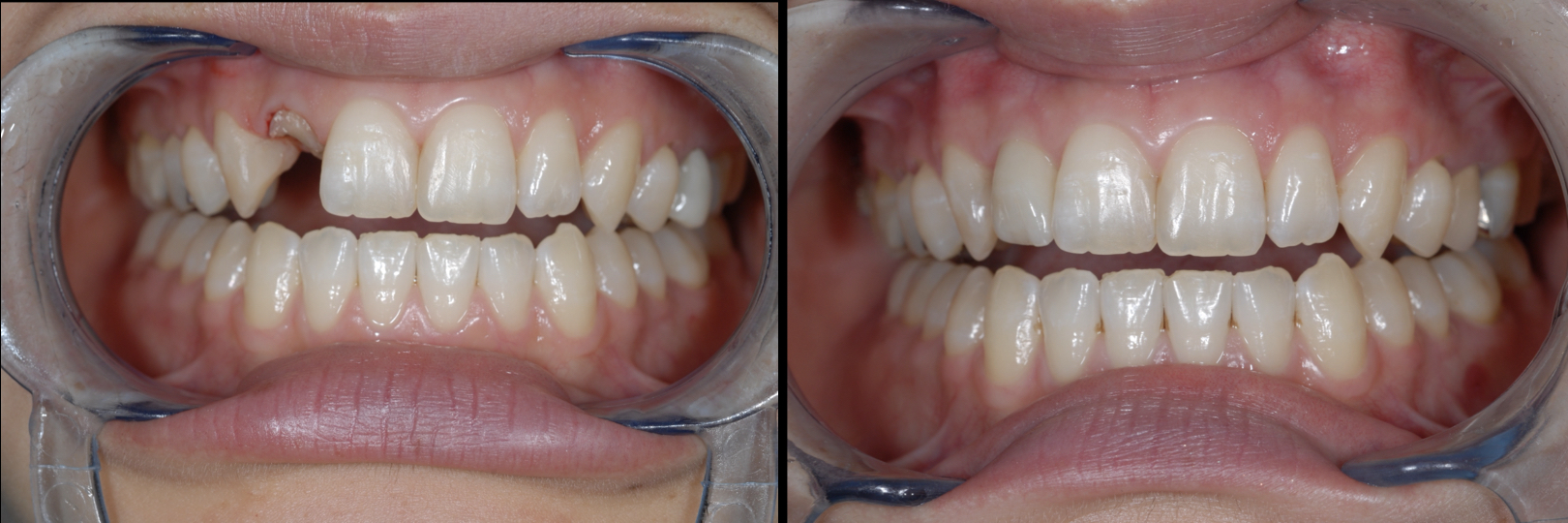 Before and After Image: Dental Implant - front