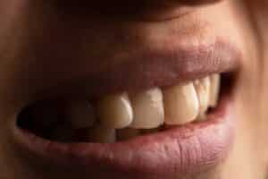 Close-up of woman’s mouth showing cracked tooth, highlighting dental issues related to tooth damage and oral health care.