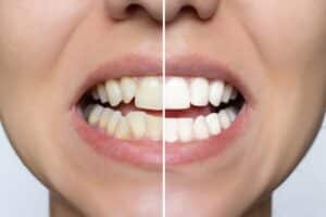 Young woman's smile before and after Six Month Smiles treatment, showing straighter, whiter teeth with veneers or braces.