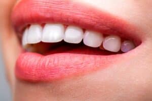 Close-up of a young woman's bright smile, symbolizing teeth whitening, dental health, and professional dental care.