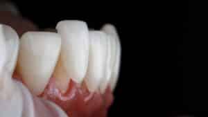 Macro dental image showing a veneer being fitted onto a short lower tooth, illustrating cosmetic solutions for improving tooth length and smile aesthetics through restorative dentistry
