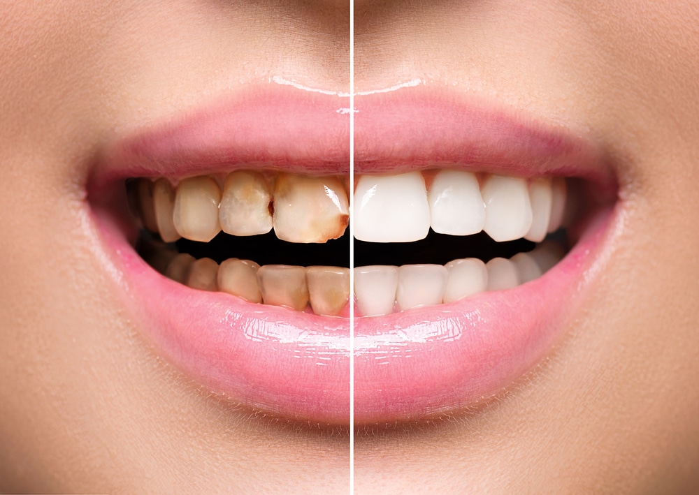 Side-by-side close-up of a woman's teeth before and after dental treatment, showcasing teeth whitening and restoration results, highlighting dental health and oral care.