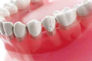 Medically accurate 3D illustration of cracked veneers and a split tooth showing dental damage