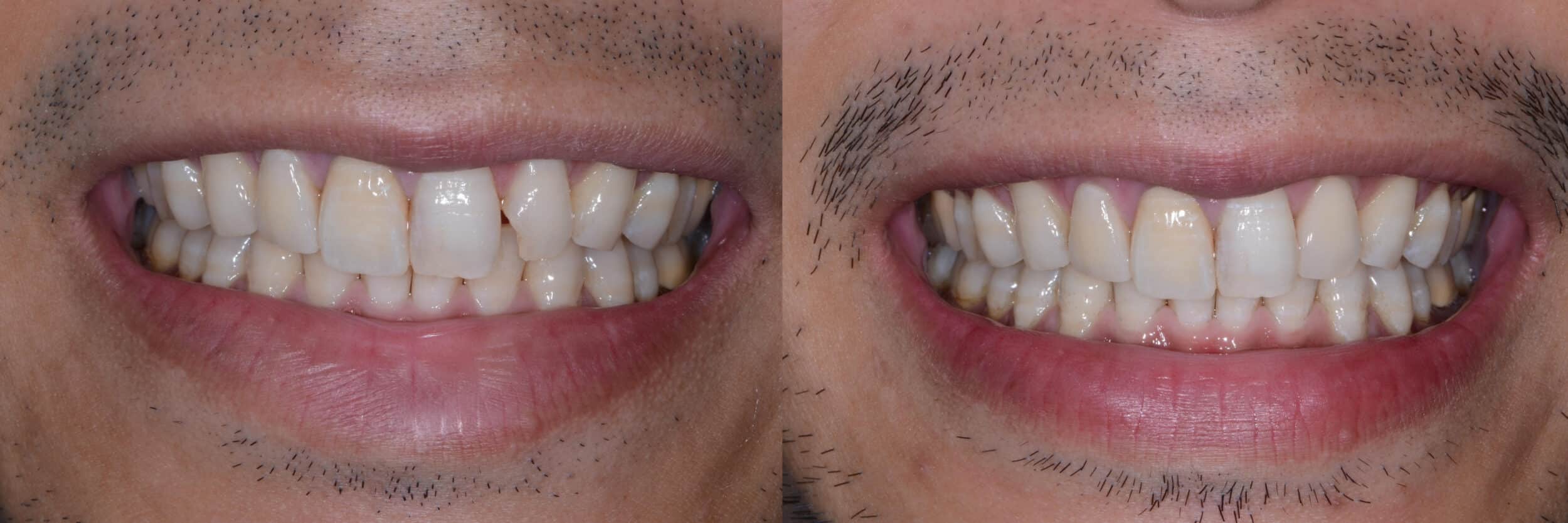 Before and After Image: Composite Bonding - front