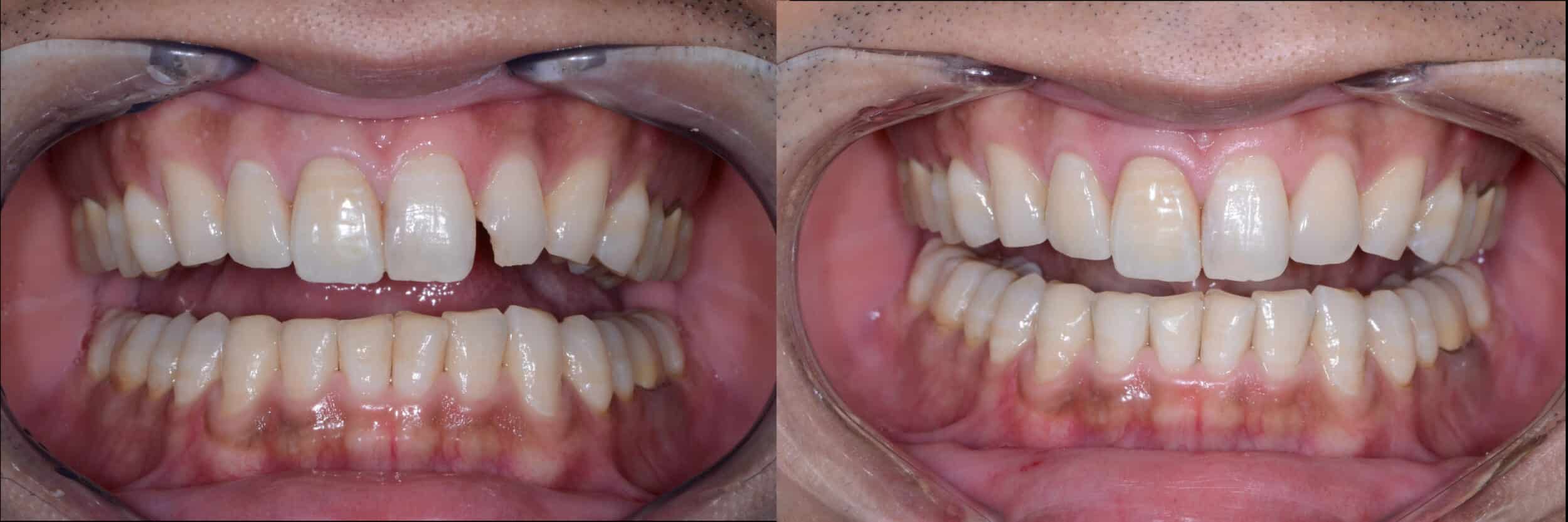 Before and After Image: Composite Bonding -