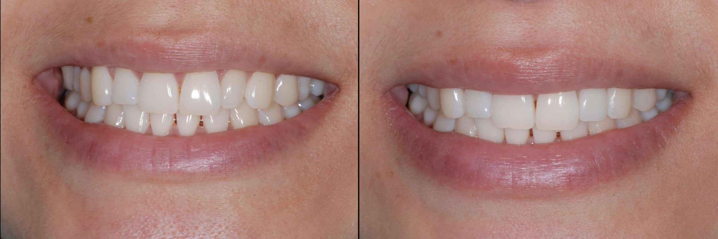 Before and After Image: Zirconia Crown - front