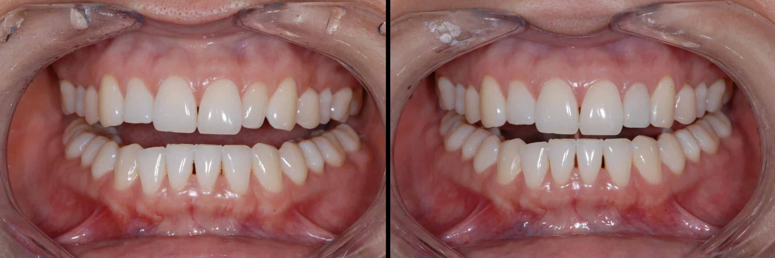 Before and After Image: Zirconia Crown -