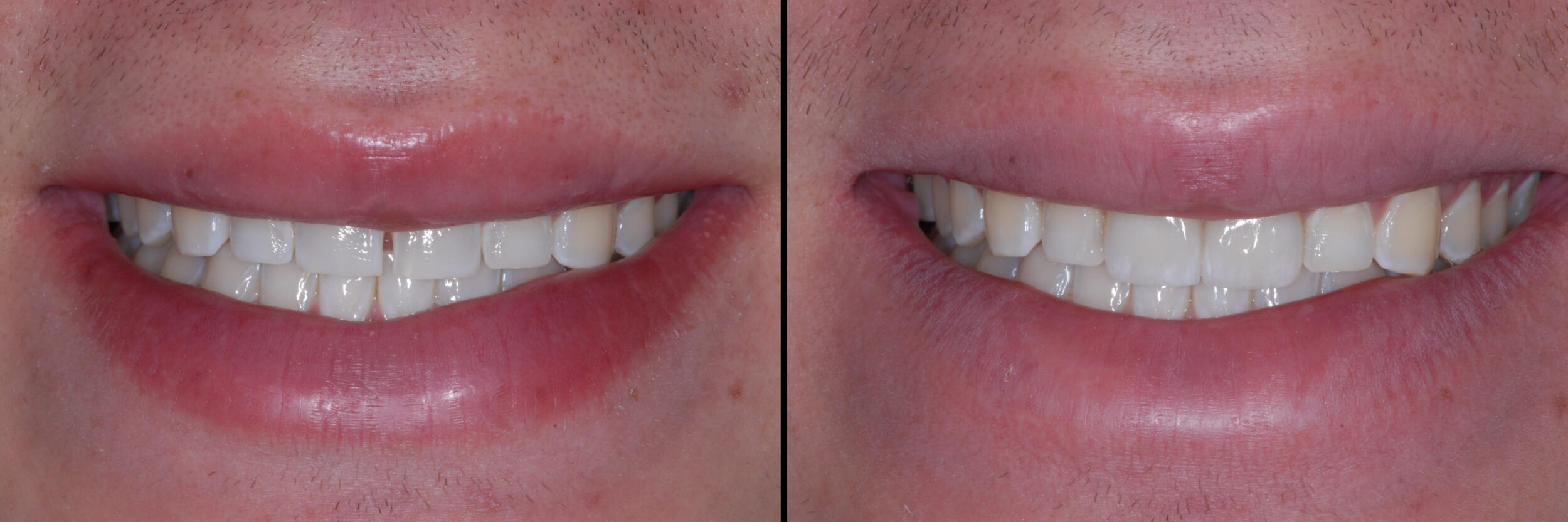 Before and After Image: Emax Veneers Diastima Closure - front