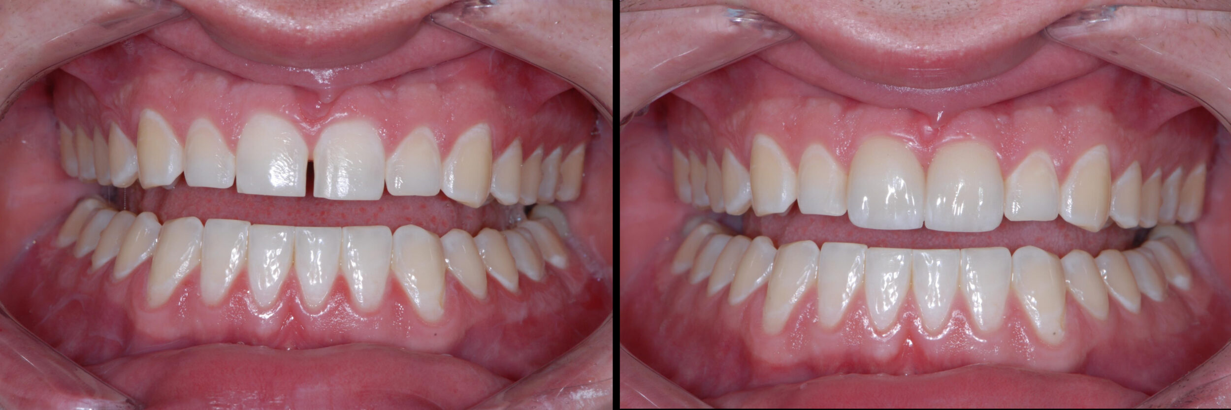 Before and After Image: Emax Veneers Diastima Closure - 
