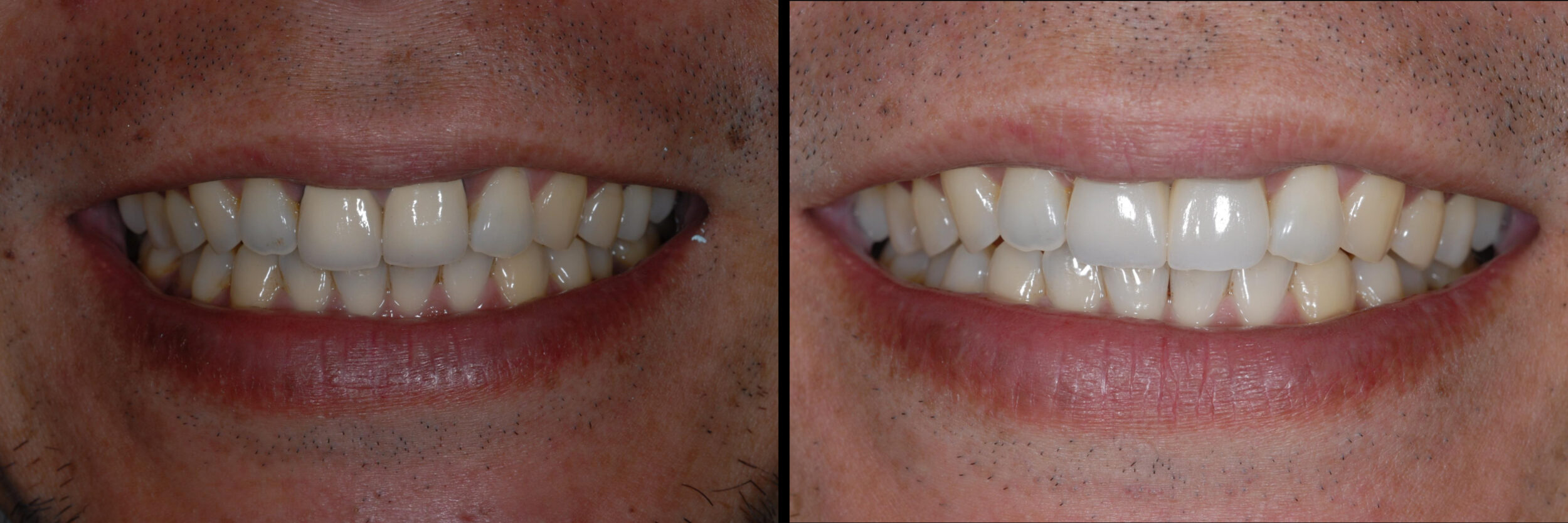 Before and After Image: Emax Crowns - front