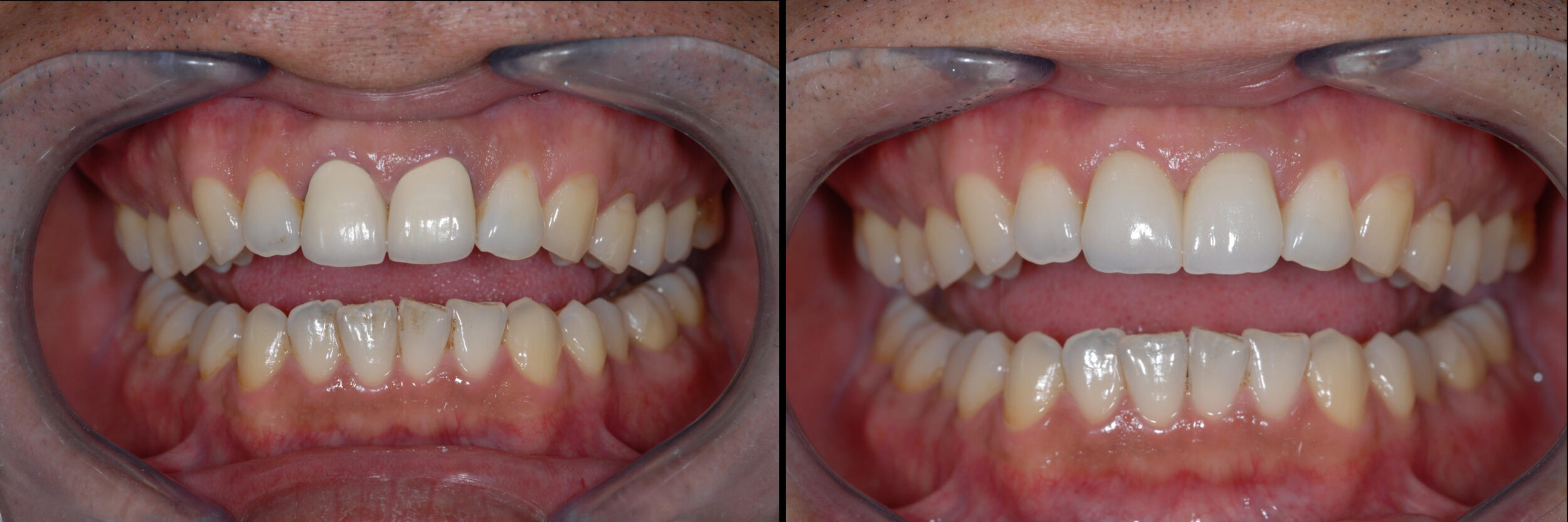Before and After Image: Emax Crowns - 