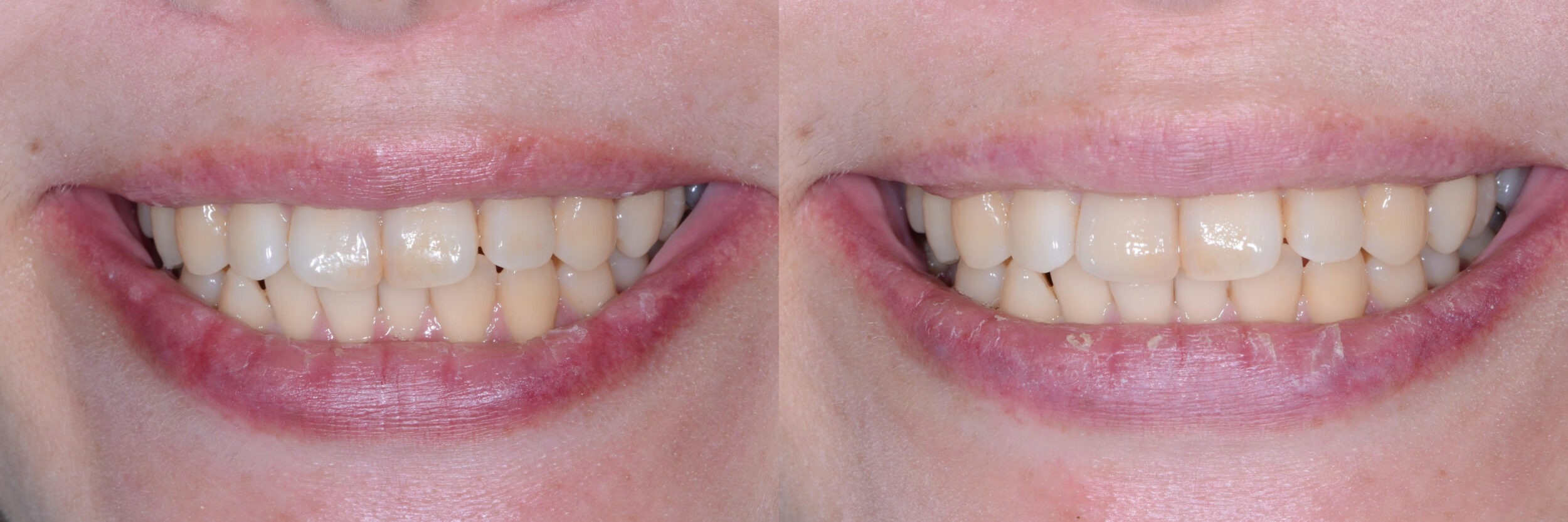 Before and After Image: Zirconia Crown after root canal treatment - front