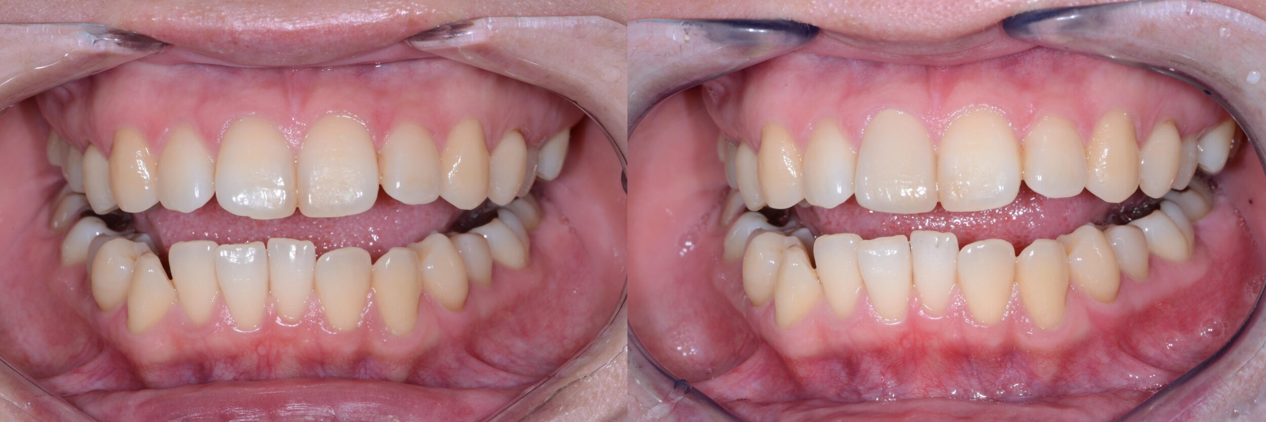 Before and After Image: Zirconia Crown after root canal treatment - 