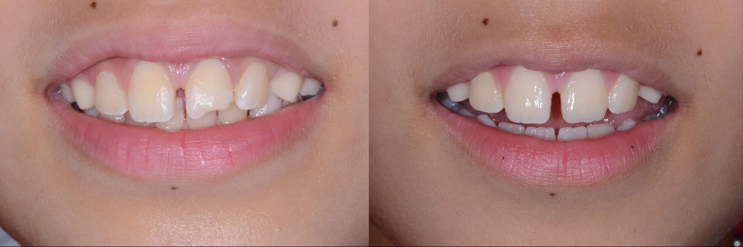 Before and After Image: Composite Bonding - front