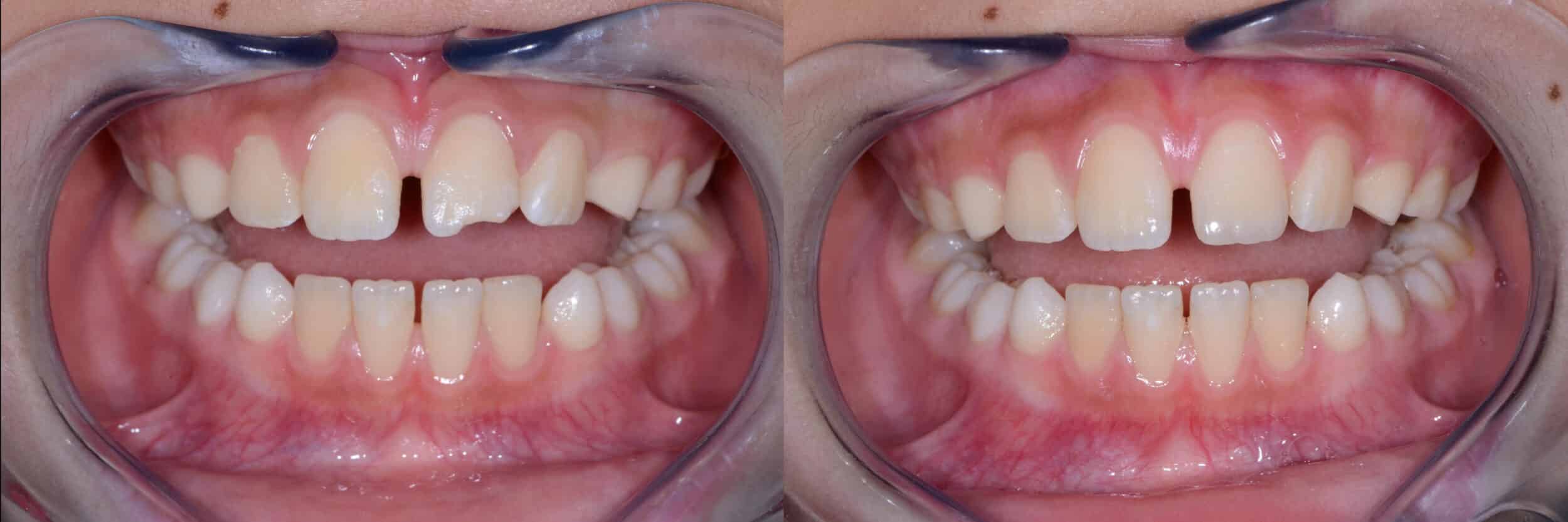 Before and After Image: Composite Bonding -