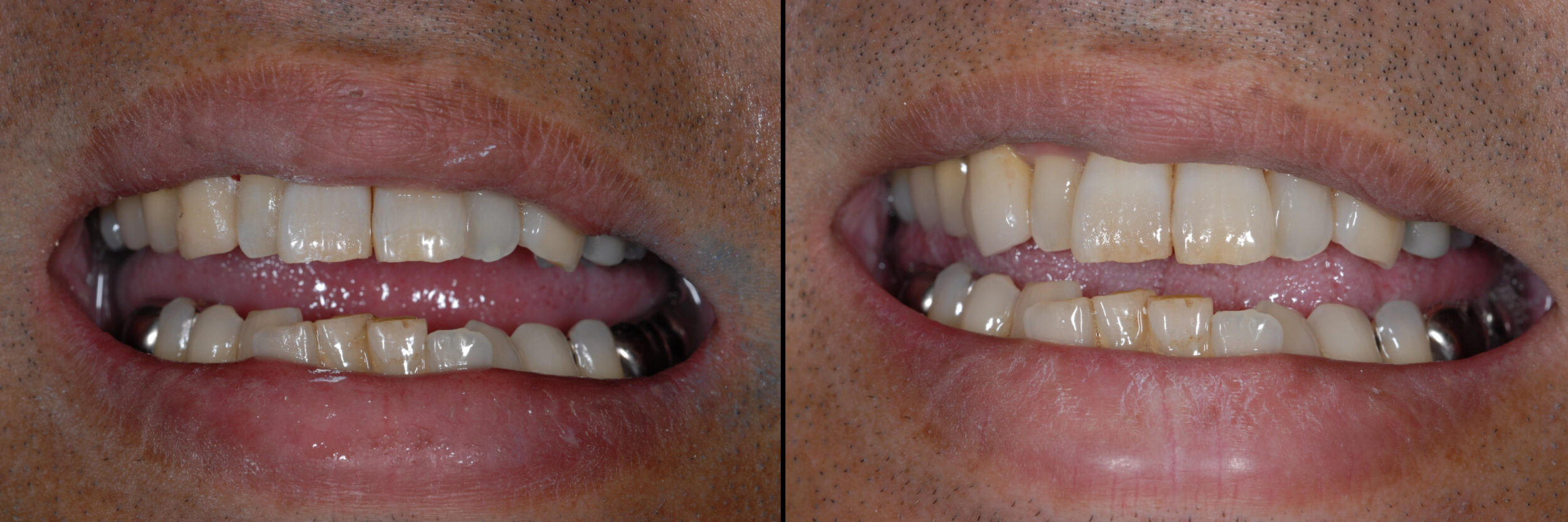 Before and After Image: Zirconia Crown - front