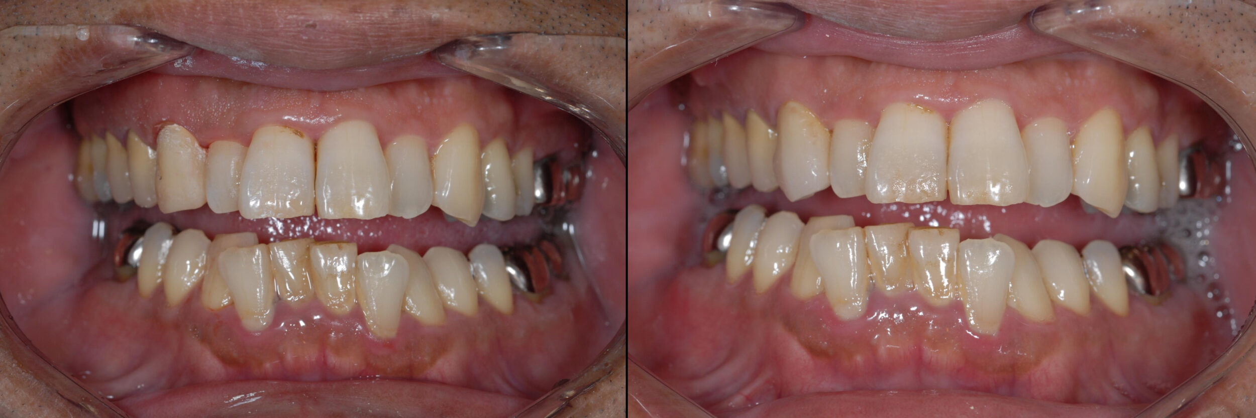 Before and After Image: Zirconia Crown - 