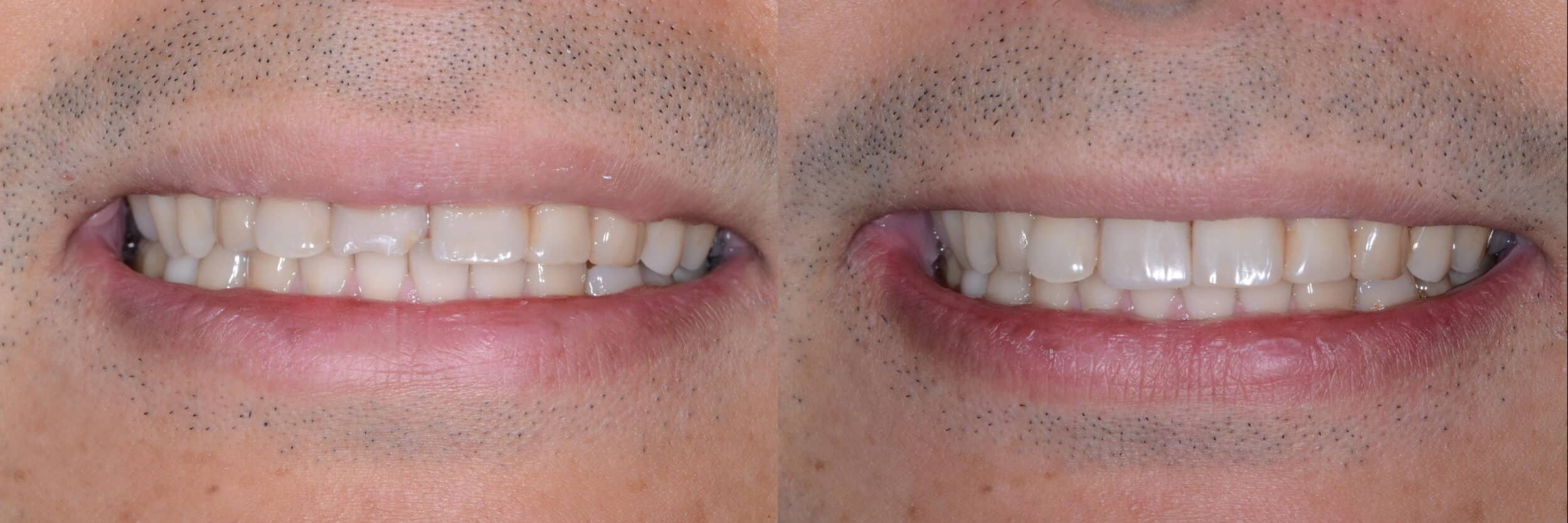 Before and After Image: Composite Bonding - front